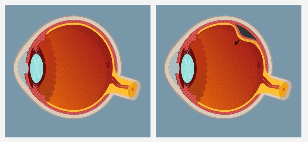 Can retinal detachment be serious - Louie Eye Care