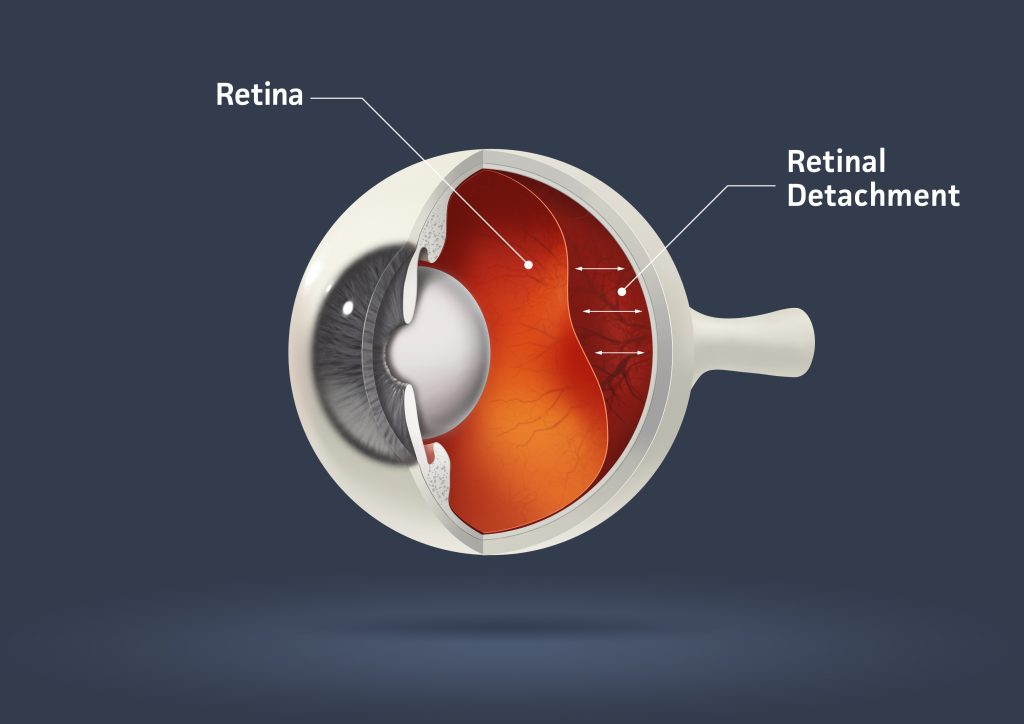 Can a detached retina fix itself - Louie Eye Care